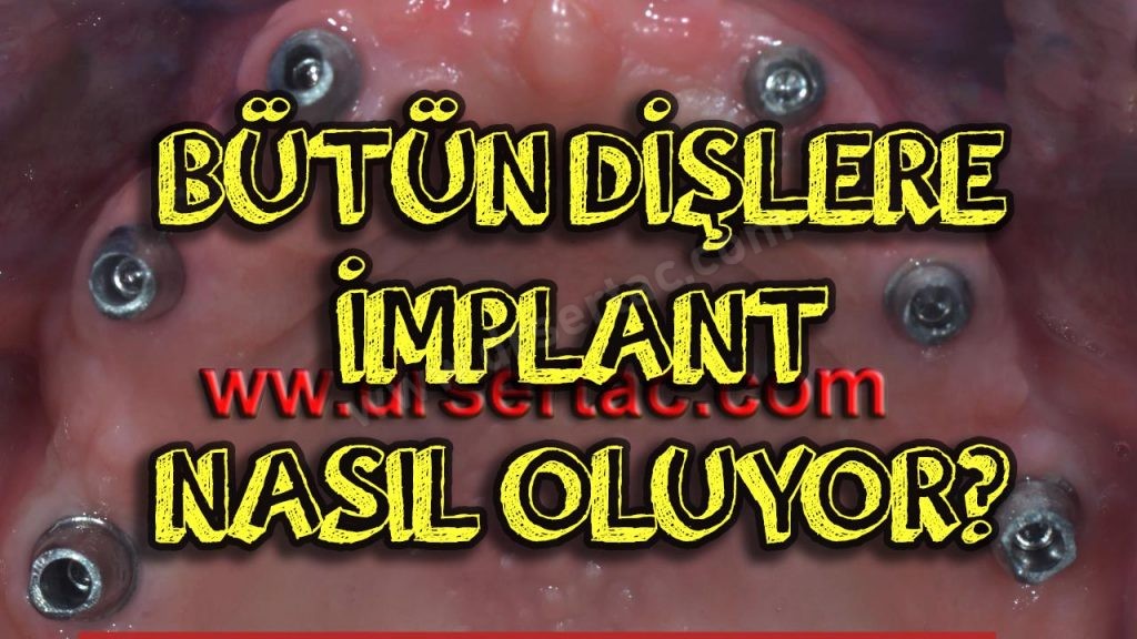 Bütün Dişlere İmplant