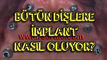 Bütün Dişlere İmplant