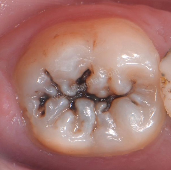ŞÜRÜK DİŞ VE TEDAVİSİ