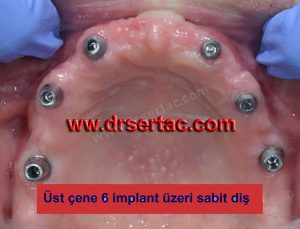 üst çene bütün dişlere implant önce sonra