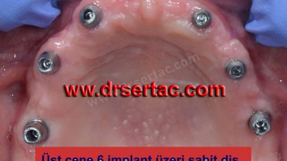 üst çene bütün dişlere implant önce sonra