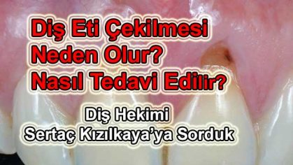 Diş eti çekilmesi